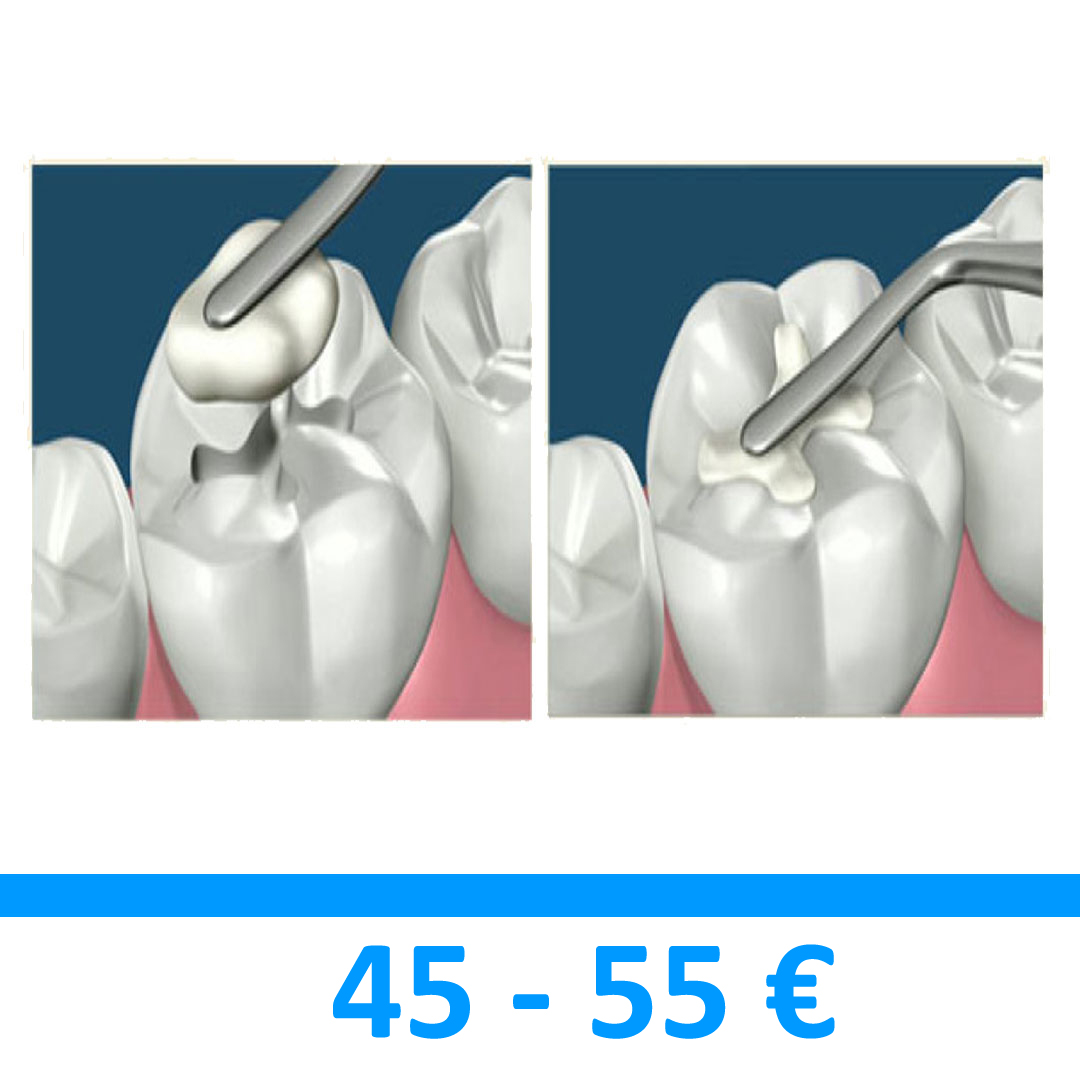 otturazione dentale estetica in materiale composito