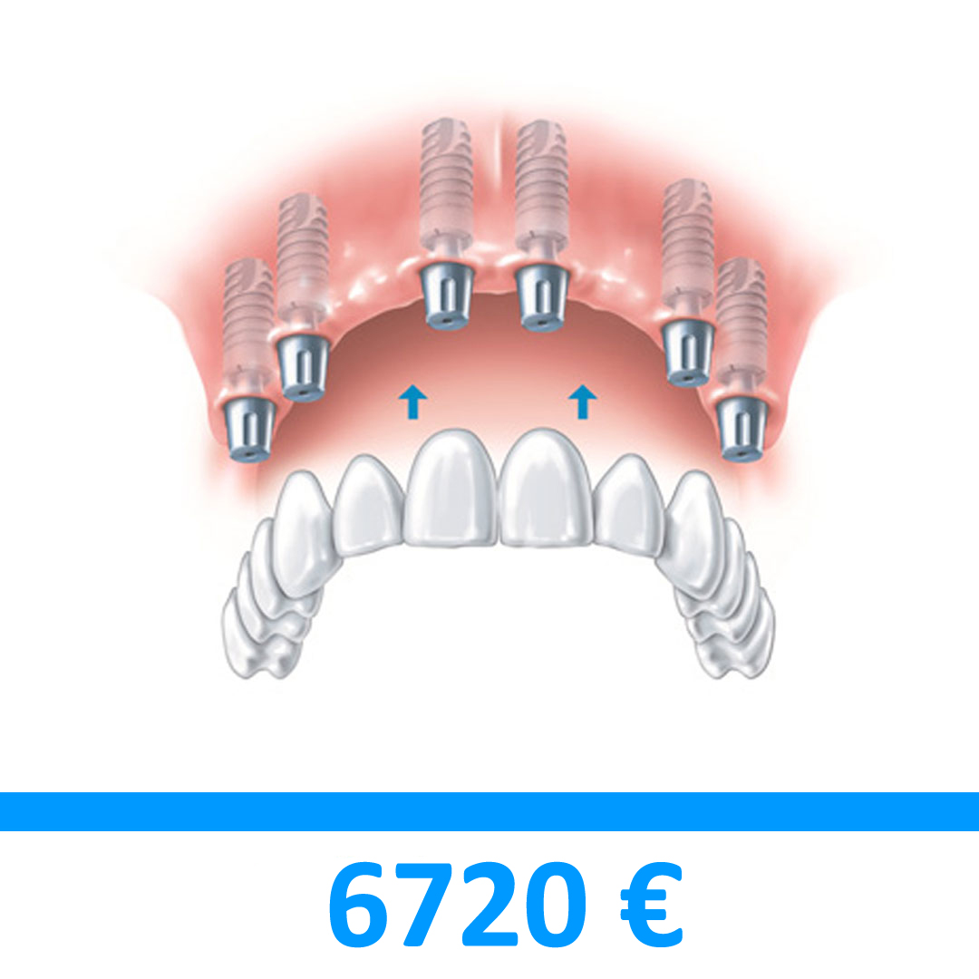 ponte circolare fisso in porcellana portato da 6 impianti