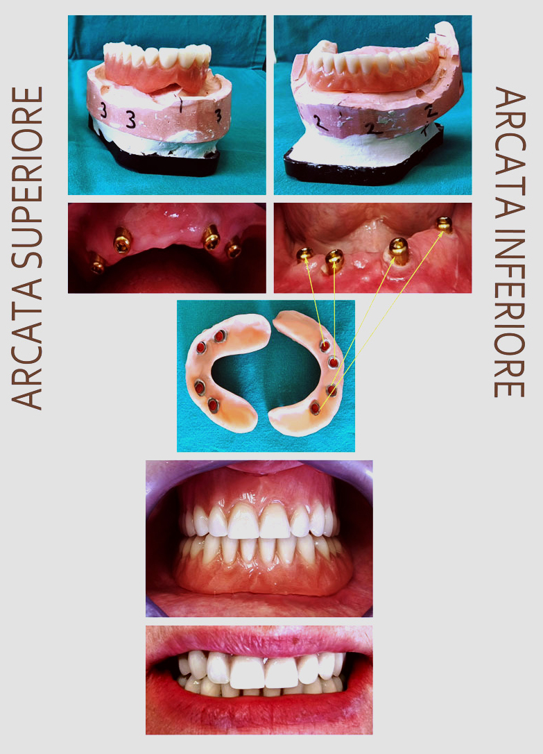 Caso clinico 1 – risultato finale del trattamento odontoiatrico