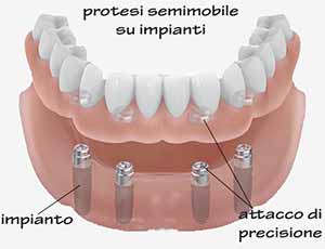 protesi semimobile